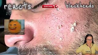 blackhead removal blackhead extraction blackhea [upl. by Adnilahs]