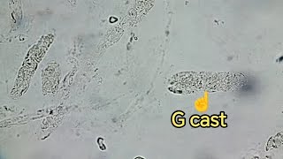 Granular cast in urine sample GUE urinalysis فحص الادرار الاسطوانات المحببة [upl. by Rehpotsyrhc]