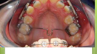 ATP To Keep Spaces IN oRTHODONTICS [upl. by Sivad615]