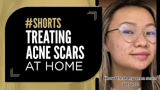 Treating Acne Scars at Home acnescars [upl. by Stempson]