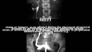 Retrograde pyelogram Top  7 Facts [upl. by Moore]