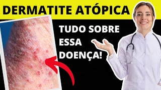 TUDO SOBRE DERMATITE ATÓPICA   O QUE É CAUSAS E TRATAMENTO [upl. by Weywadt]