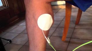 Complete Achilles Tendon Rupture Electronic Muscle Stimulation Rehab [upl. by Anwahsar35]