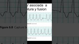 Criterios Morfológicos para Diagnosticar Taquicardias Bloqueo de Rama y Activación Ventricular [upl. by Arlana]