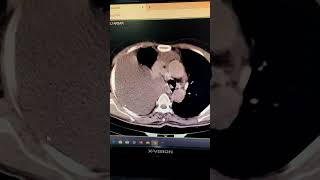 Massive plural effusion before and after thoracentesis [upl. by Gaulin8]