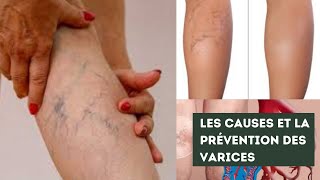 Comment prévenir et traiter les varices et les varicosités [upl. by Atiekan585]