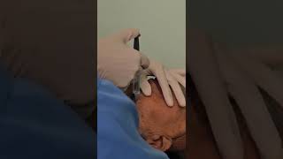 RETROBULBAR ANESTHESIA CATRACT SURGERY ophthalmology mbbs medico doctor surgeon anestesia [upl. by Ellis]