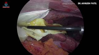 HYDATID CYST LIVER [upl. by Dine]