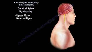 Cervical Spine Myelopathy amp Radiculopathy [upl. by Burnsed17]