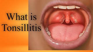 What is Tonsillitis Tonsils Kia hain Bachun me tonsils ka ilaj in UrduHindi [upl. by Kared]