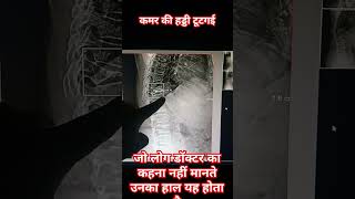 स्पाइन एक्सरे टूटी हुई कमर की हड्डी youtuber youtubeshort bonefracture facts [upl. by Acisseg723]