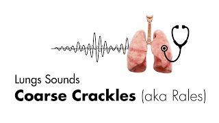 Coarse Crackles Rales  Lung Sounds  Medzcool [upl. by Nierman287]