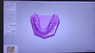 3Shape Aufbissschiene [upl. by Chin]