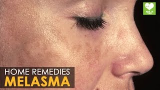 Melasma Treatment Cure  Home Remedies  Health Tips [upl. by Ettennod]