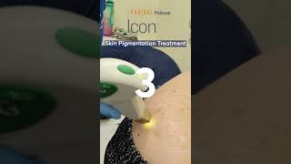 Skin Pigmentation Treatment Icon Laser [upl. by Nishom477]