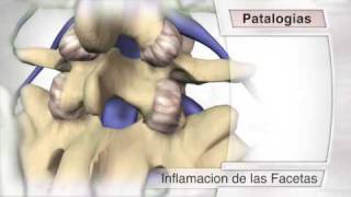 Sindrome Facetario [upl. by Oam]