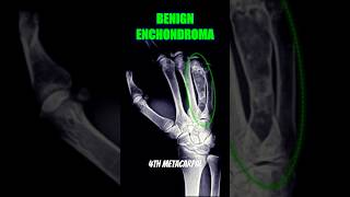 Enchondroma bones xray health [upl. by Lister]