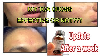 DIY TCA CROSS  Update after 1st Session using 100 Solution [upl. by Eloisa327]