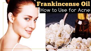 Frankincense Essential Oil for Acne How to Use It [upl. by Acihsay398]