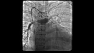 Central Shunt in Pulmonary atresia [upl. by Gere398]