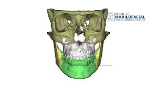 Double jaw surgery Case  72 Iria  Class 2 Biretrusion open bite [upl. by Renckens]