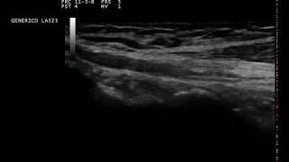 Ulnar nerve entrapment ultrasound [upl. by Yelsek]