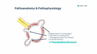 Diverticular Disease Diverticulitis  Introduction  Abdominal painAcute abdomen [upl. by Crisey]