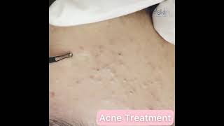 Comedone Extraction Acne Treatment [upl. by Maziar]