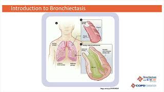 Introduction to Bronchiectasis with Tim Aksamit MD [upl. by Sivahc646]