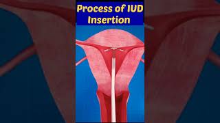 Process Of IUD Insertion viral shorts contraceptives pregnancytips [upl. by Akihsay]