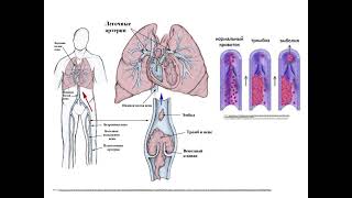 Thrombosis EmbolismViolations microcirculation [upl. by Ynalem725]