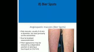 3 Acquired hypomelanosis by Dr Mohamed Aidaros [upl. by Eimoan438]