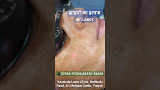 Pigmentation Removal Laser Treatment [upl. by Eldin]