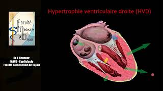 Cours ECG Pathologique 4eme Année [upl. by Ydurt452]