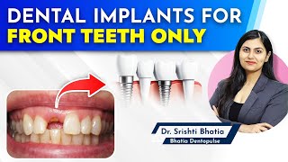 Dental Implants for FRONT TEETH only Dr Srishti Bhatia implants dentist newteeth [upl. by Ettenwad125]