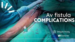 Complications of AV Fistula or Dialysis Fistula and Management [upl. by Odelle]