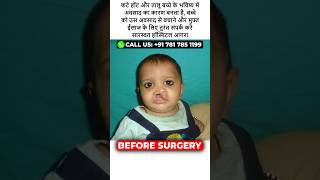 Cleft Lip and Palate Surgery at Saraswat Hospital at Agra [upl. by Odysseus]