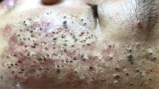 Blackhead Removal With Sac Dep Spa 100074091 [upl. by Nesto]