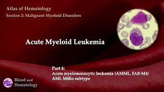 Acute Myeloid Leukemia AML  Part 4 [upl. by Ylrebma]