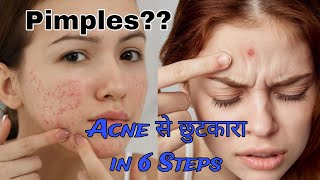 How To Remove Pimples  How To Get Rid Of Pimples  Acne video viralvideo youtubevideo acne diy [upl. by Yung365]