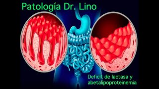 Anatomía patológica  Síndrome de Malabsorción  Deficiencia de lactasa y abetalipoproteinemia [upl. by Ojahtnamas]