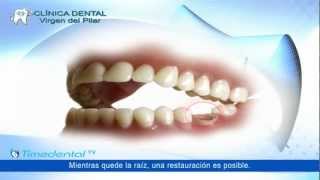 ¿Qué es la prótesis dental fija por Clínica Virgen del Pilar [upl. by Lleksah]