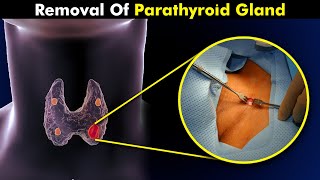 How Parathyroidectomy is Performed  Removal Of Parathyroid Gland [upl. by Dewie]