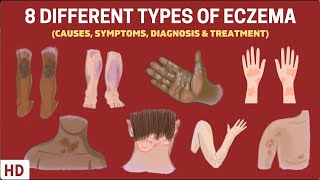 Eczema Exposed 8 Types You Need to Know [upl. by Evin915]