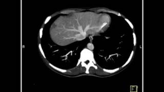 Abdomen Liver Cavernous Hemangioma of the Liver9 of 9 [upl. by Eeldivad]