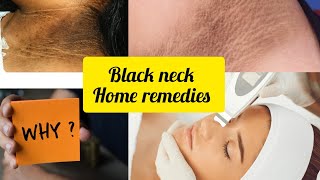 how to remove black neck home remedies [upl. by Nilyarg351]