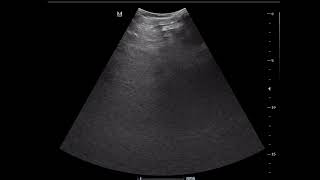 CASE 1094 CONGESTIVE HEPATOPATHY [upl. by Stutsman85]