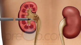 PreOp® Kidney Stone Procedures  Patient Education  Urology Center [upl. by Komarek]