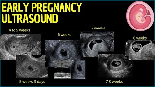 Early Pregnancy Ultrasound A Deep Dive into First Trimester Insights pregnancyultrasound [upl. by Sigvard]