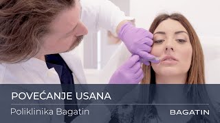 Povećanje usana dermalnim filerima u Poliklinici Bagatin [upl. by Cicenia]